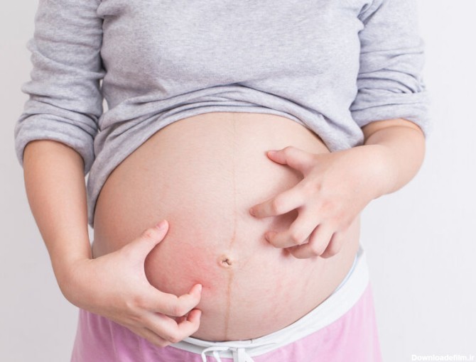 خارش ناف در بارداری