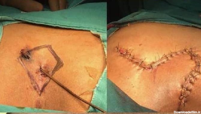 عکس عمل جراحی کیست مویی با روش باز و بسته