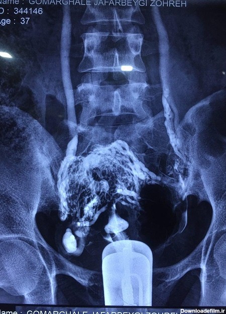 هيستروسالپنگوگرافي با ماده حاجب یکی از انواع عکسهای رادیولوژی با ...