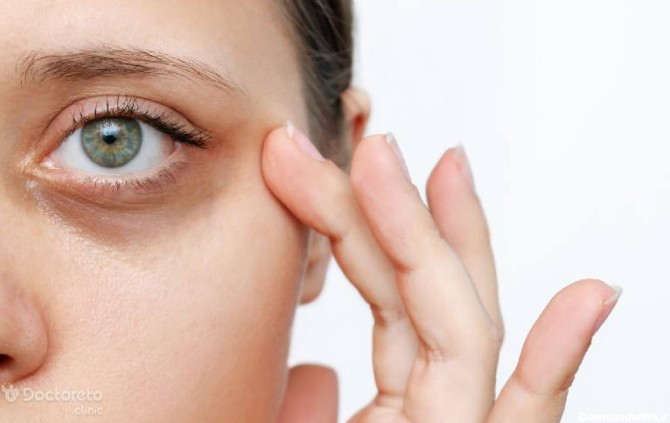 علت سیاهی دور چشم چیست و چگونه آن را درمان کنیم؟ – مجله سلامت دکترتو