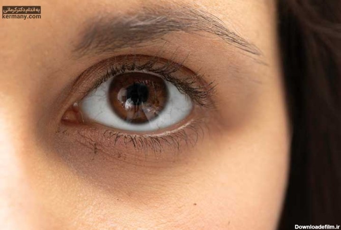 سیاهی زیر چشم چه دلایلی دارد و بهترین درمان آن چیست؟ | دکتر کرمانی