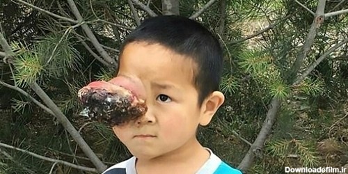 توموری عجیب در چشم پسر خردسال چینی+تصاویر | خبرگزاری فارس