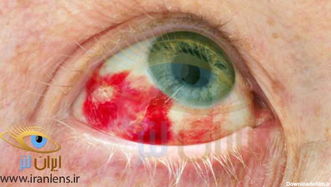 علائم خرابی لنز چشم و عفونت چشمی