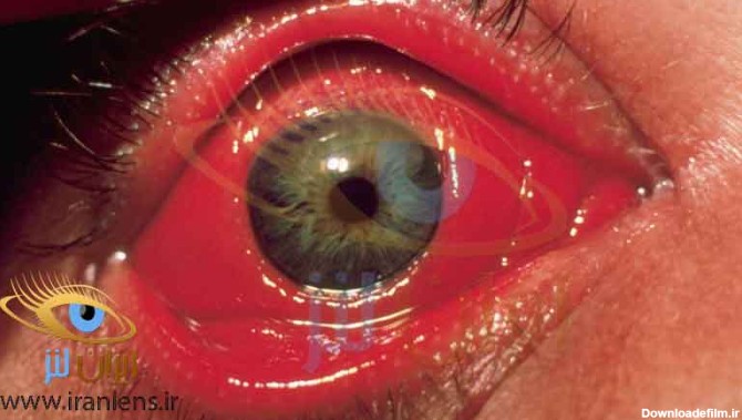 عوامل خرابی لنز چشم