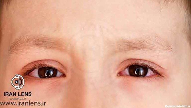 ضعیفی چشم در کودکان و بررسی علائم اختلالات بینایی در آن ها | ایران لنز