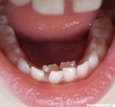 نیفتادن دندان شیری نی نی سایت - دکتر یوسف رفیع دندانپزشک زیبایی در کرج
