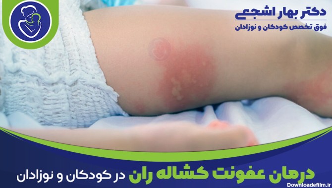 درمان عفونت کشاله ران در کودکان