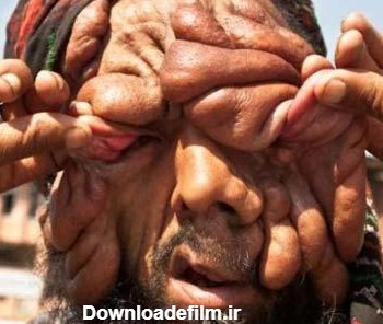 چهره ترسناک و عجیب یک مرد هندی!! (تصاویر 18+)