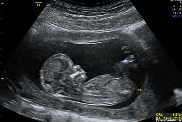 غربالگری سه ماهه اول بارداری (NT) | سونوگرافی و رادیولوژی دیجیتال ...