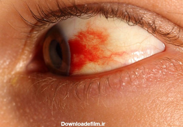 خونریزی چشم را چگونه در خانه درمان کنیم؟ | لنز و عینک لوناتو