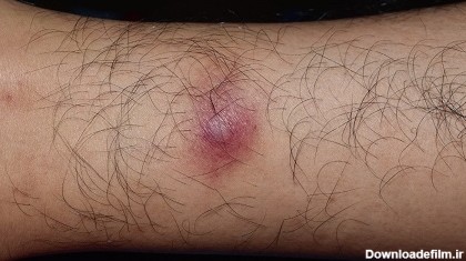 عفونت پوستی ناشی از نیش حشرات: علل ، علائم و درمان