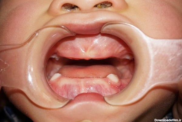 دندان در نیاوردن کودک - دكتر فرزين اصلاني فوق تخصص ارتودنسی اطفال ...