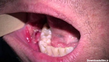 زگیل دهانی را چگونه درمان کنم؟علائم و تفاوت آفت و زگیل دهانی