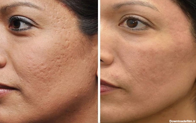 درمان جای جوش صورت با طب سنتی با روش آسان | کلینیک صدف