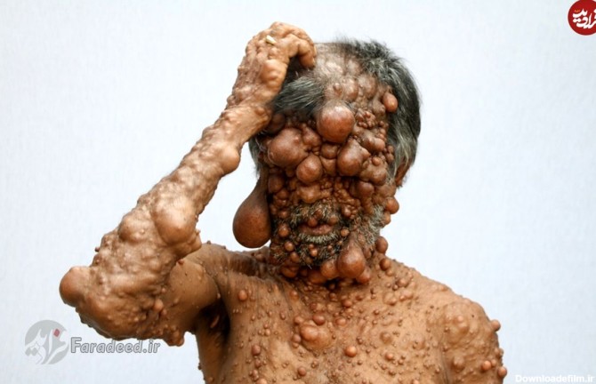 تصاویر+16/ تومورهای حبابی مرد بنگلادشی