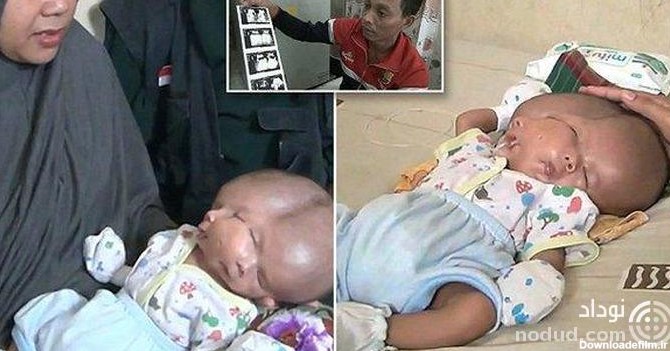 تولد نوزادی با دو مغز جهان را شوکه کرد ! + عکس
