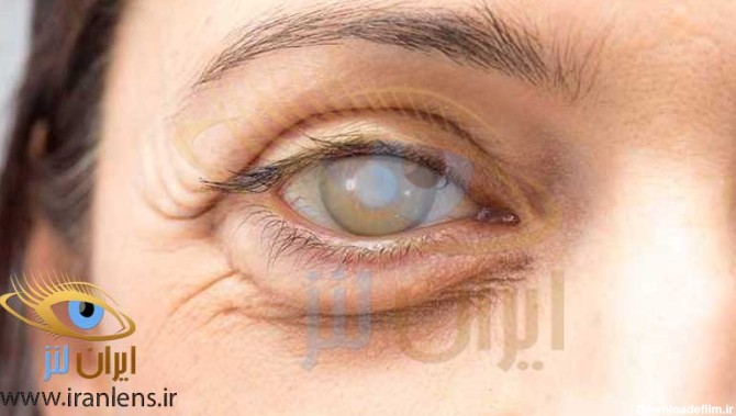 علائم و روش های جلوگیری از ضعیف شدن چشم ها چیست؟ | فروشگاه ایران لنز