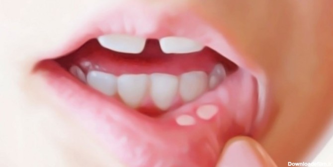 علت آفت زدن دهان چیست؟ | خبرگزاری فارس