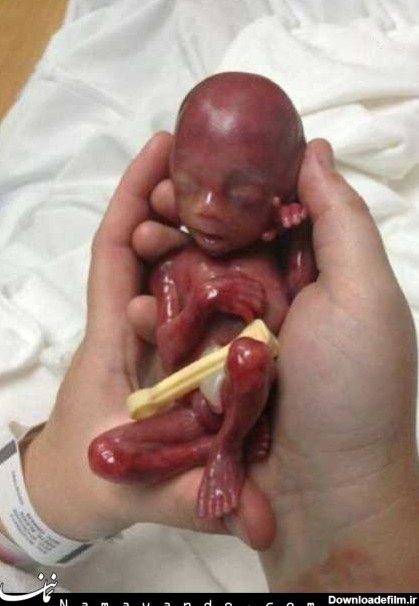 به دنیا آمدن جنین سقط شده نوزده هفته ای!+تصاویر (۱۳+) - پایگاه ...