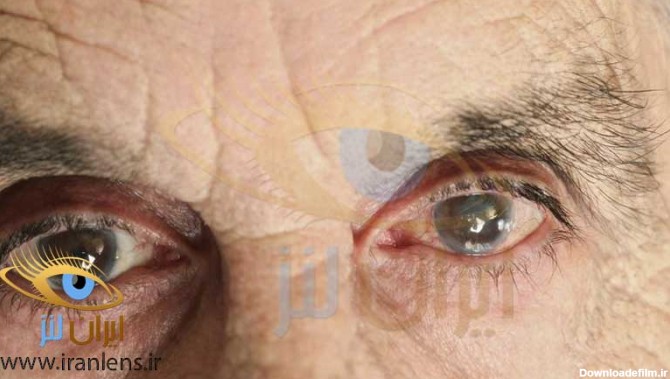 درمان بیماری گلوکوم چشم