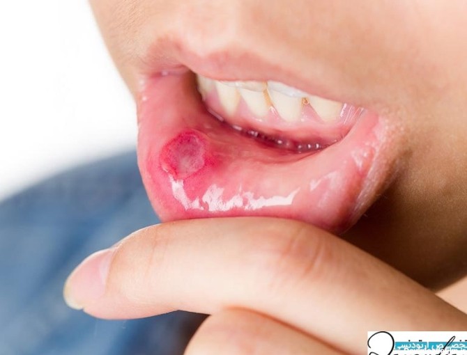 آفت دهان چیست و بهترین روش برای درمان سریع آفت دهان