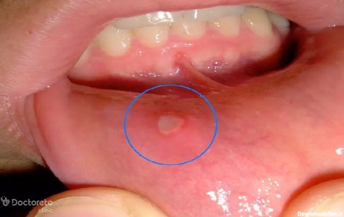 ۹ علت اصلی زخم دهان | چگونه می‌توان انواع زخم‌های دهان و زبان را ...