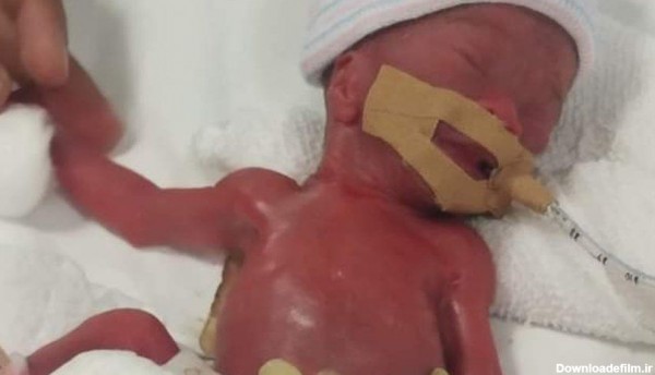 فرارو | (تصاویر) کوچک‌ترین نوزاد دنیا از بیمارستان مرخص شد
