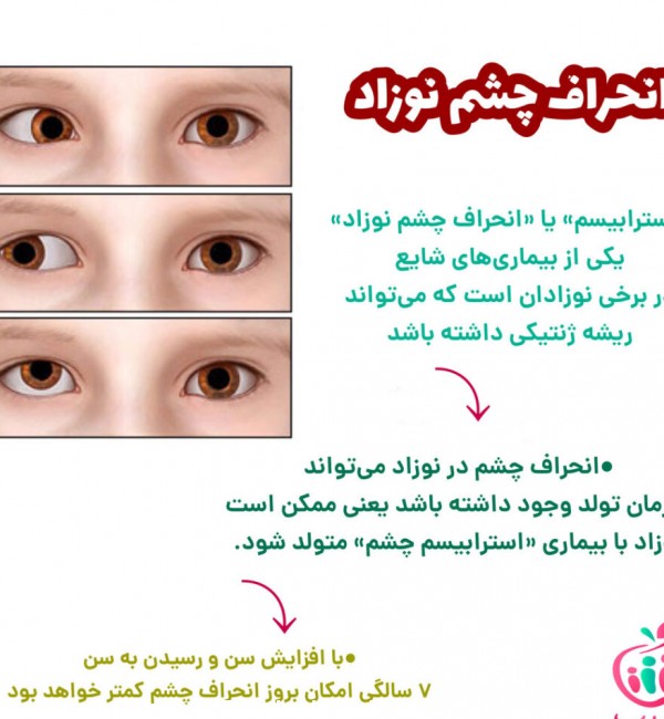 همه روش های تشخیص و درمان انحراف چشم نوزاد - ۳۰ سیب سایت جامع ...