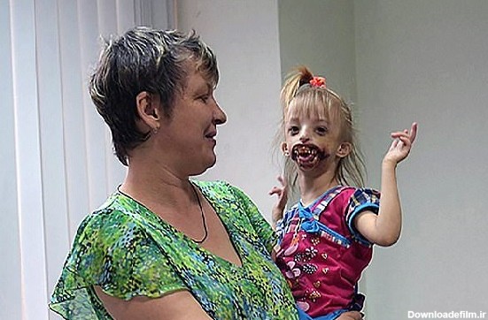 دختر بچه روسی بدون لب و چانه+ تصاویر