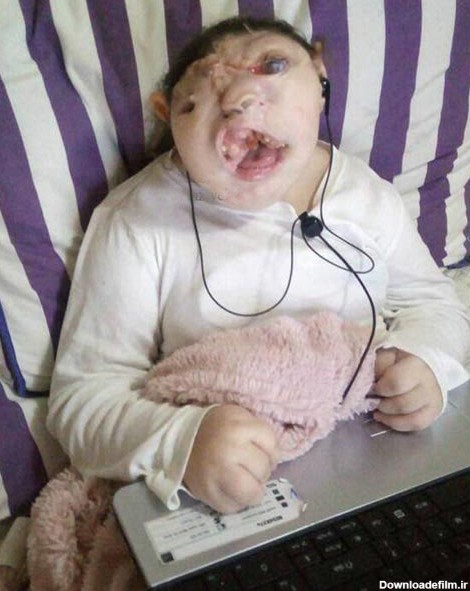 بیماری بسیار ترسناک این دختر بچه او را شبیه به هیولا کرد+ تصاویر ...