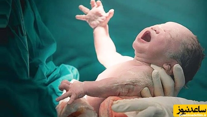 ویدئو) تولد یک نوزاد سمج با آینده ای درخشان در جامعه/ چسبیده به ...