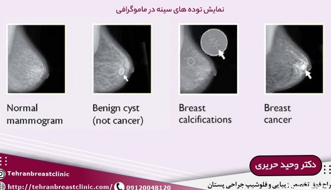 تشخیص سرطان سینه | روش سونوگرافی، ماموگرافی،MRI، آزمایش خون