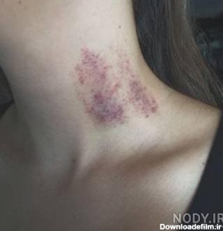 عکس کبودی روی گردن
