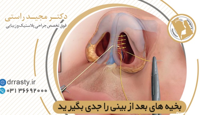بخیه های بعد از جراحی بینی را جدی بگیرید|جراح بینی اصفهان