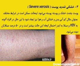 11 علامت پوستی ابتلا به بیماری ایدز + تصویر - کیت HIV