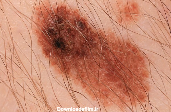 5 نوع خال مشکوک به سرطان پوست - عکس انواع خال سرطانی