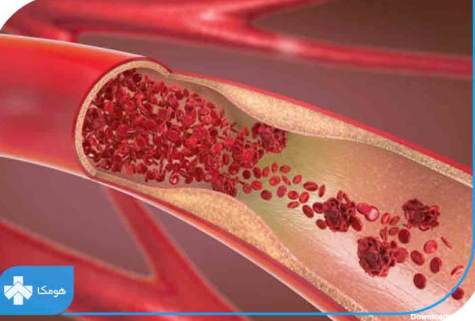 لخته شدن خون قاعدگی چیست؟ + درمان خونریزی سنگین قاعدگی | مجله هومکا