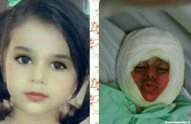 دختر بچه ای که در دیگ نذری سقوط کرده بود فوت کرد +عکس