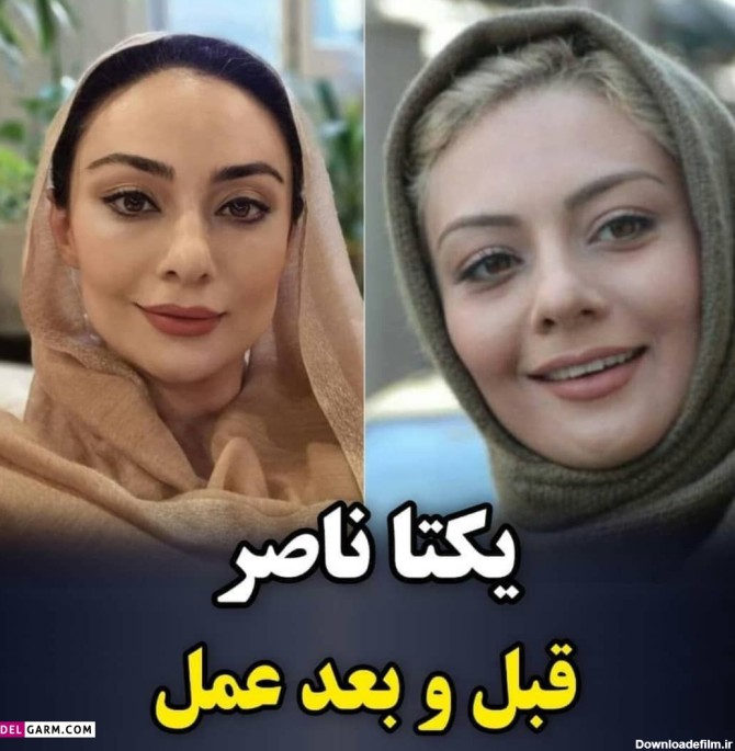 بازیگران زن ایرانی قبل عمل زیبایی / باور کردنی نیست!