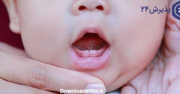 دندان درآوردن نوزاد | علائم و مراقبت ها | پذیرش۲۴