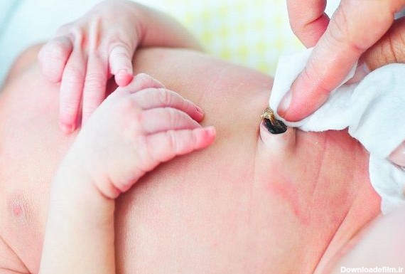 8 ویژگی ترشحات ناف نوزاد در هنگام عفونت