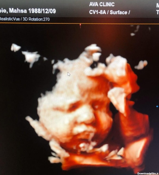 سونوگرافی سه بعدی جنین چیست و آیا این روش امن است ؟ - موسسه ...
