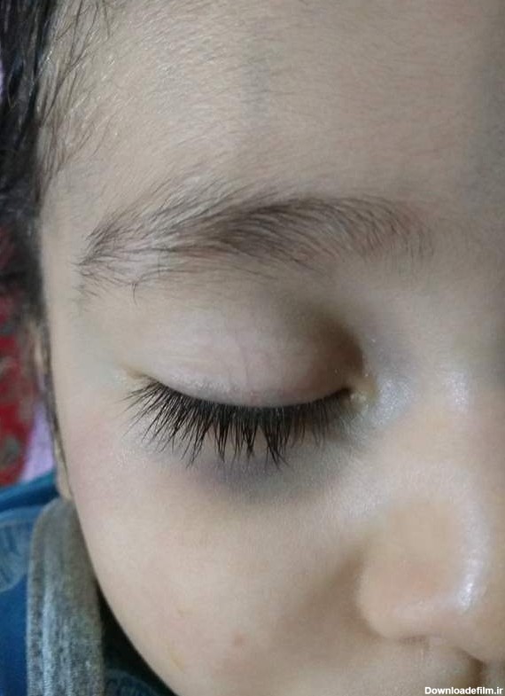 کبودی چشم پسرم+عکس | تبادل نظر نی نی سایت