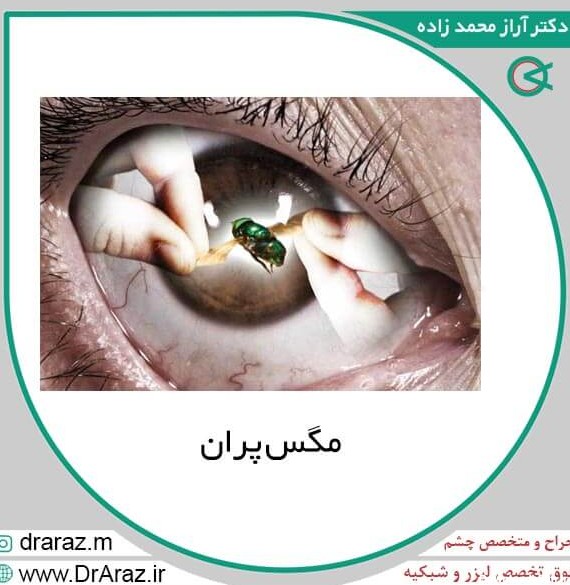 مگس پران | بهترین جراح و متخصص چشم تبریز | دکتر آراز محمدزاده