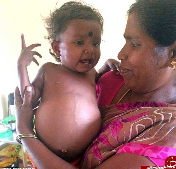 نوزاد دختر هنگام تولد، دوقلو باردار بود! - تابناک | TABNAK