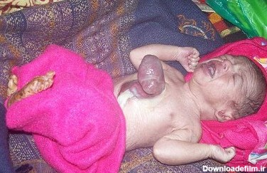 تولد نوزاد هندی با قلب خارج از بدن (+عکس)
