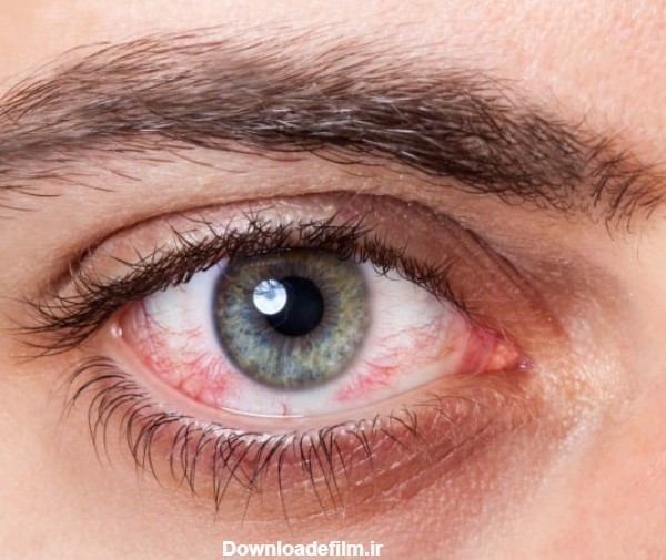علل اصلی لکه خون در چشم و 8 درمان خانگی خونریزی زیر ملتحمه چشم