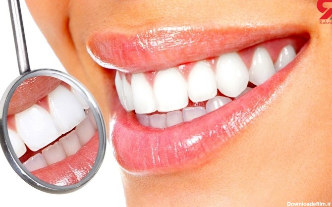 سفید کردن دندان ها با ترفندهای خانگی