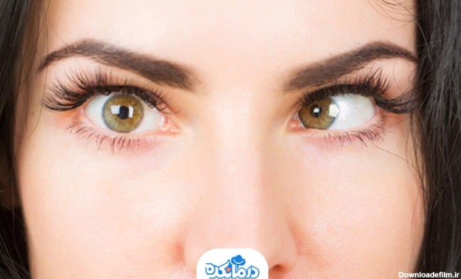 انحراف چشم یا استرابیسموس چیست؟ علت، علائم + درمان خانگی