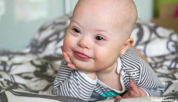 نوزاد مبتلا به سندرم داون: نیاز ها و روشهای نگهداری و مراقبت
